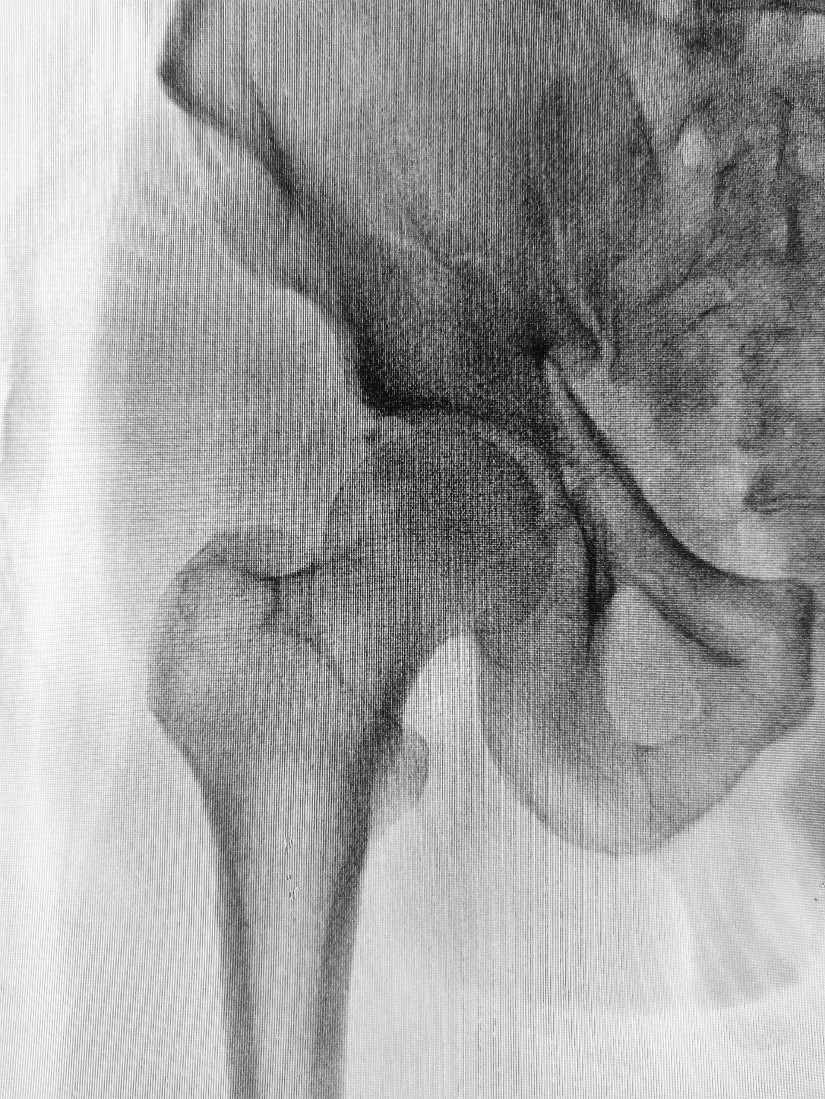 An image showing an x ray of a fractured hip. Kora suffered from a fractured hip and has since received surgery to correct the damage. 